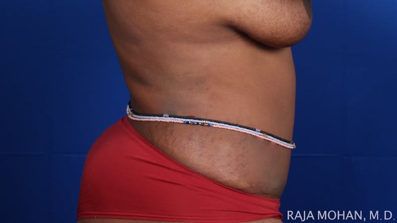 Tummy Tuck Before & After Gallery - Patient 354479 - Image 8