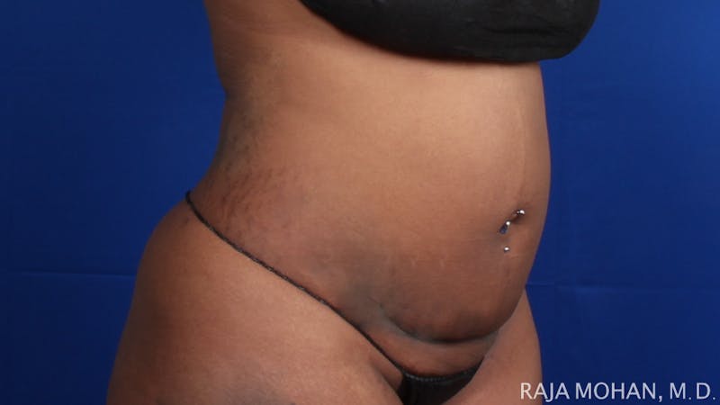 Tummy Tuck Before & After Gallery - Patient 354479 - Image 9