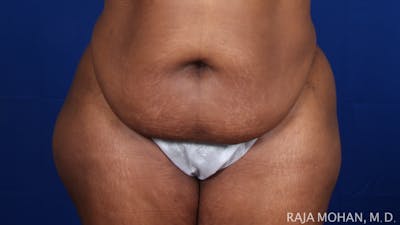Tummy Tuck Before & After Gallery - Patient 315946 - Image 1