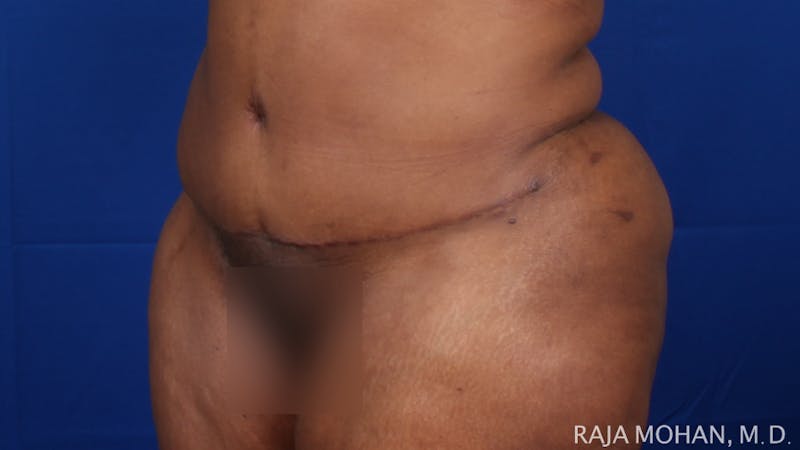 Tummy Tuck Before & After Gallery - Patient 315946 - Image 4