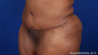 Tummy Tuck Before & After Gallery - Patient 315946 - Image 4