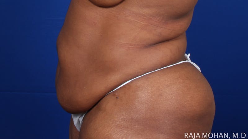 Tummy Tuck Before & After Gallery - Patient 315946 - Image 5