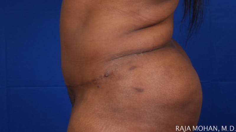 Tummy Tuck Before & After Gallery - Patient 315946 - Image 6