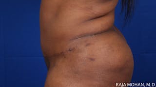 Tummy Tuck Before & After Gallery - Patient 315946 - Image 6
