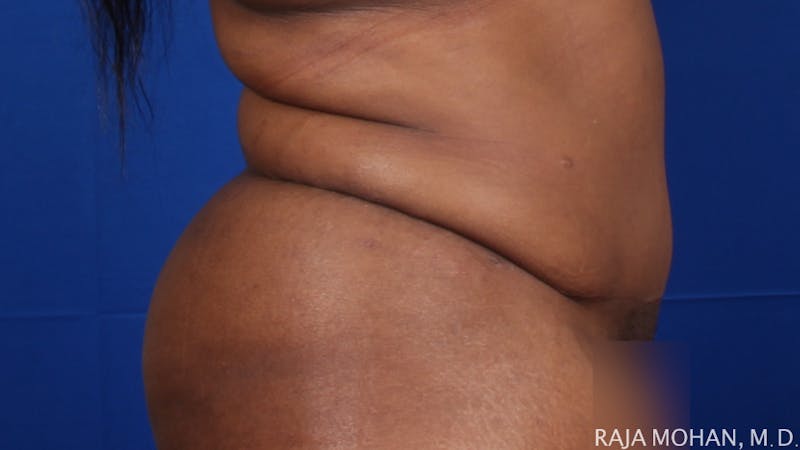 Tummy Tuck Before & After Gallery - Patient 315946 - Image 8