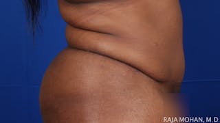 Tummy Tuck Before & After Gallery - Patient 315946 - Image 8