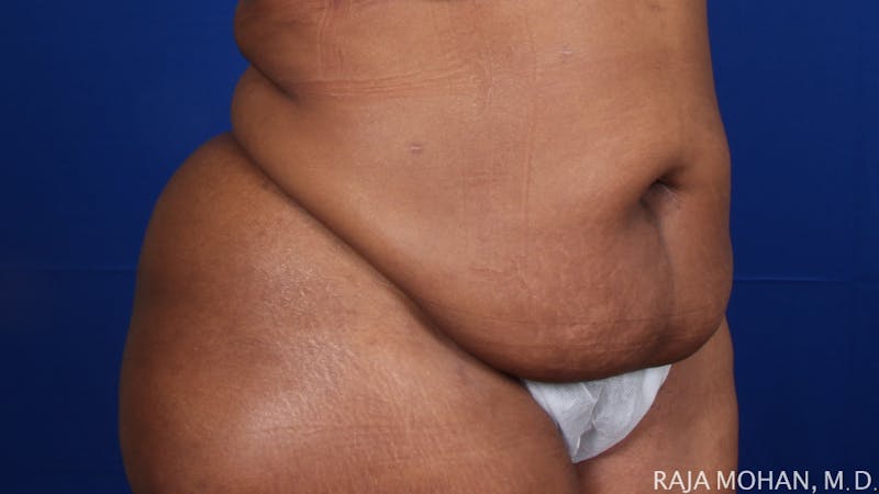 Tummy Tuck Before & After Gallery - Patient 315946 - Image 9
