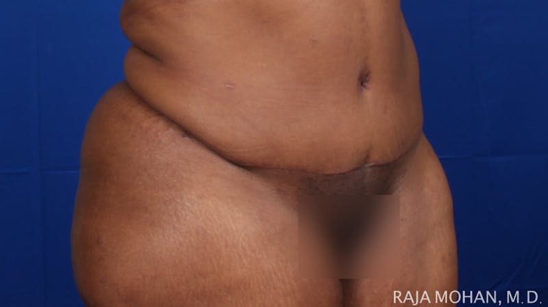 Tummy Tuck Before & After Gallery - Patient 315946 - Image 10