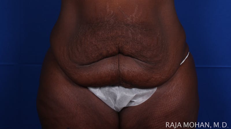Tummy Tuck Before & After Gallery - Patient 144220 - Image 1