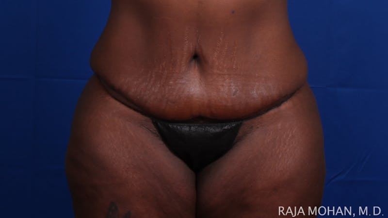 Tummy Tuck Before & After Gallery - Patient 144220 - Image 2