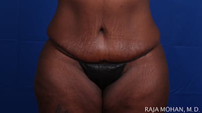 Tummy Tuck Before & After Gallery - Patient 144220 - Image 2