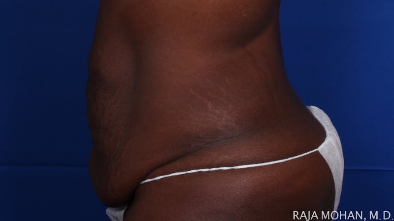 Tummy Tuck Before & After Gallery - Patient 144220 - Image 3