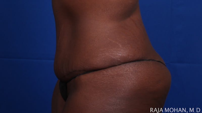 Tummy Tuck Before & After Gallery - Patient 144220 - Image 4
