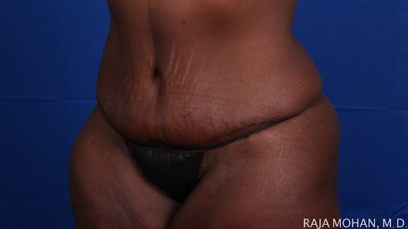 Tummy Tuck Before & After Gallery - Patient 144220 - Image 6