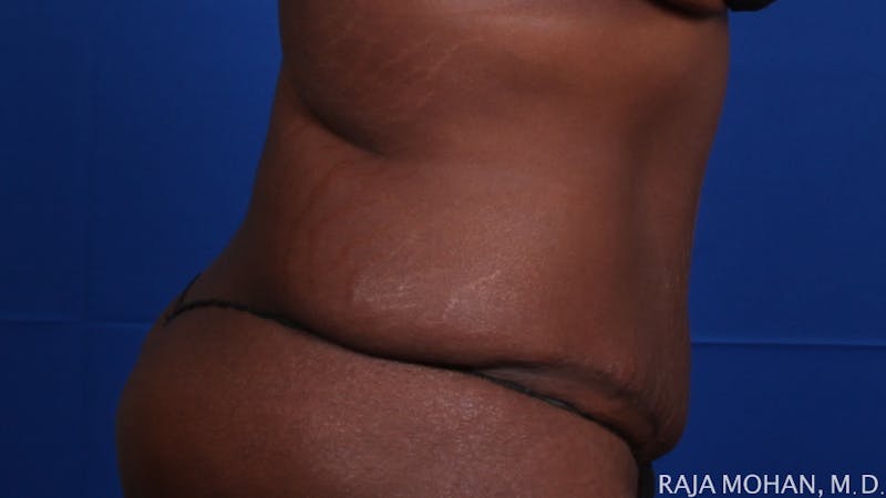 Tummy Tuck Before & After Gallery - Patient 144220 - Image 8