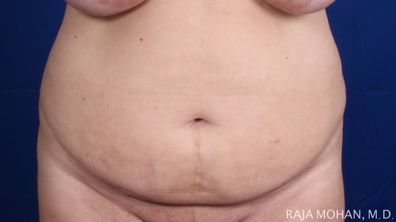 Tummy Tuck Before & After Gallery - Patient 116764 - Image 1