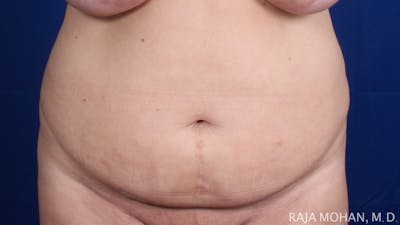 Tummy Tuck Before & After Gallery - Patient 116764 - Image 1