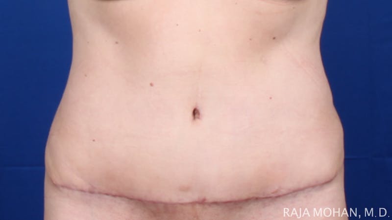 Tummy Tuck Before & After Gallery - Patient 116764 - Image 2
