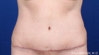 Tummy Tuck Before & After Gallery - Patient 116764 - Image 2