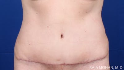Tummy Tuck Before & After Gallery - Patient 116764 - Image 2