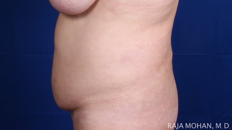 Tummy Tuck Before & After Gallery - Patient 116764 - Image 3