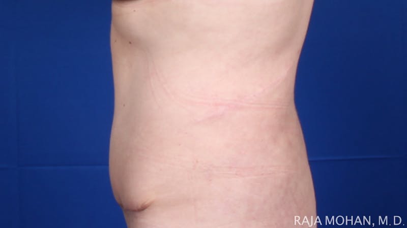 Tummy Tuck Before & After Gallery - Patient 116764 - Image 4