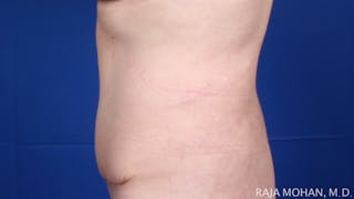 Tummy Tuck Before & After Gallery - Patient 116764 - Image 4