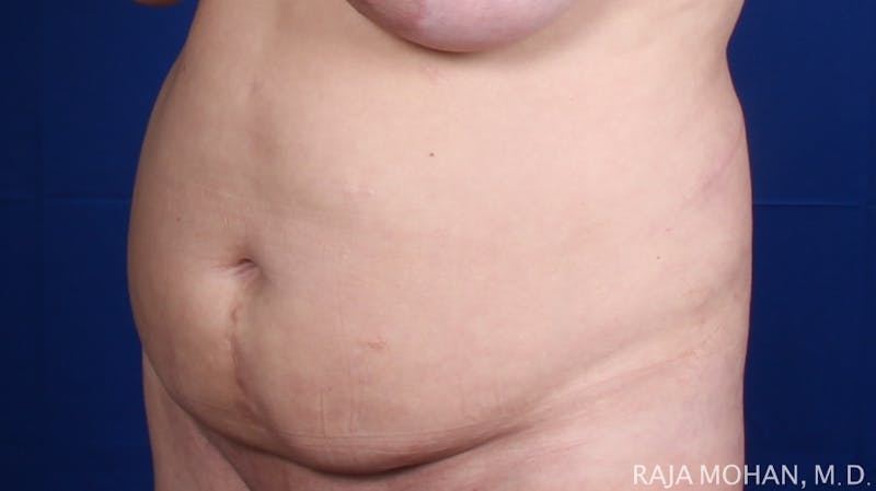 Tummy Tuck Before & After Gallery - Patient 116764 - Image 5
