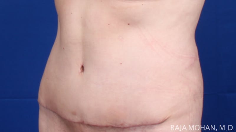 Tummy Tuck Before & After Gallery - Patient 116764 - Image 6