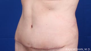 Tummy Tuck Before & After Gallery - Patient 116764 - Image 6