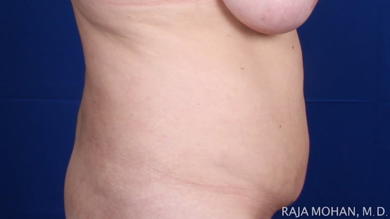 Tummy Tuck Before & After Gallery - Patient 116764 - Image 7