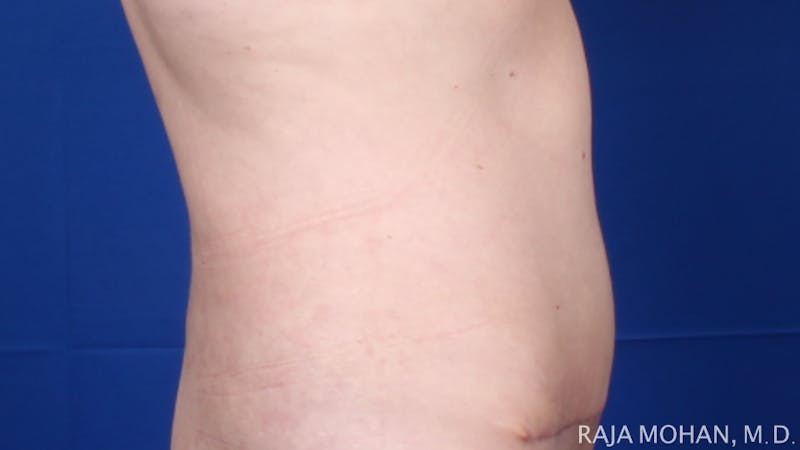 Tummy Tuck Before & After Gallery - Patient 116764 - Image 8