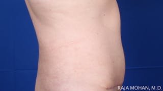 Tummy Tuck Before & After Gallery - Patient 116764 - Image 8
