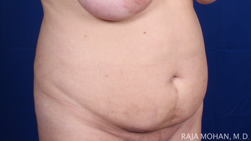 Tummy Tuck Before & After Gallery - Patient 116764 - Image 9