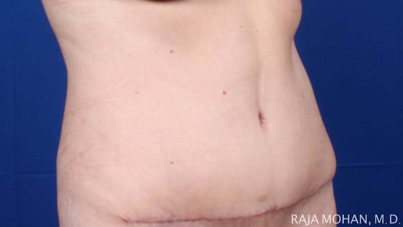 Tummy Tuck Before & After Gallery - Patient 116764 - Image 10