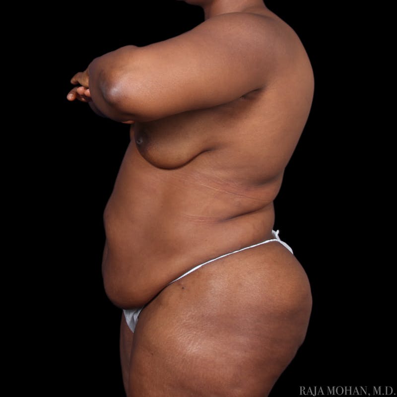Tummy Tuck Before & After Gallery - Patient 273345 - Image 3
