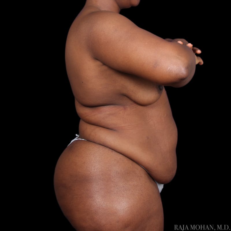 Tummy Tuck Before & After Gallery - Patient 273345 - Image 7