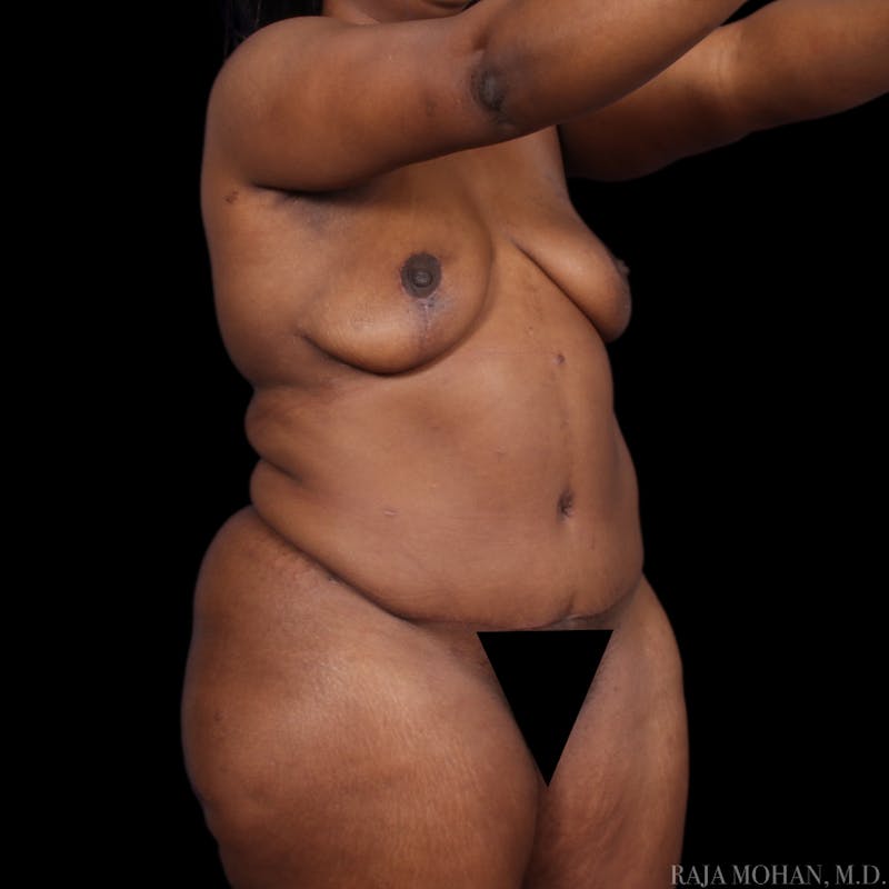 Tummy Tuck Before & After Gallery - Patient 273345 - Image 10