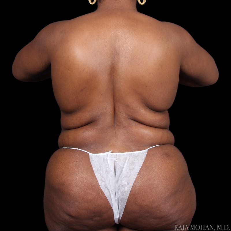Tummy Tuck Before & After Gallery - Patient 273345 - Image 11
