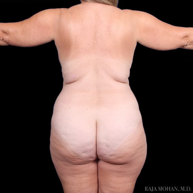 Tummy Tuck Before & After Gallery - Patient 166422 - Image 11