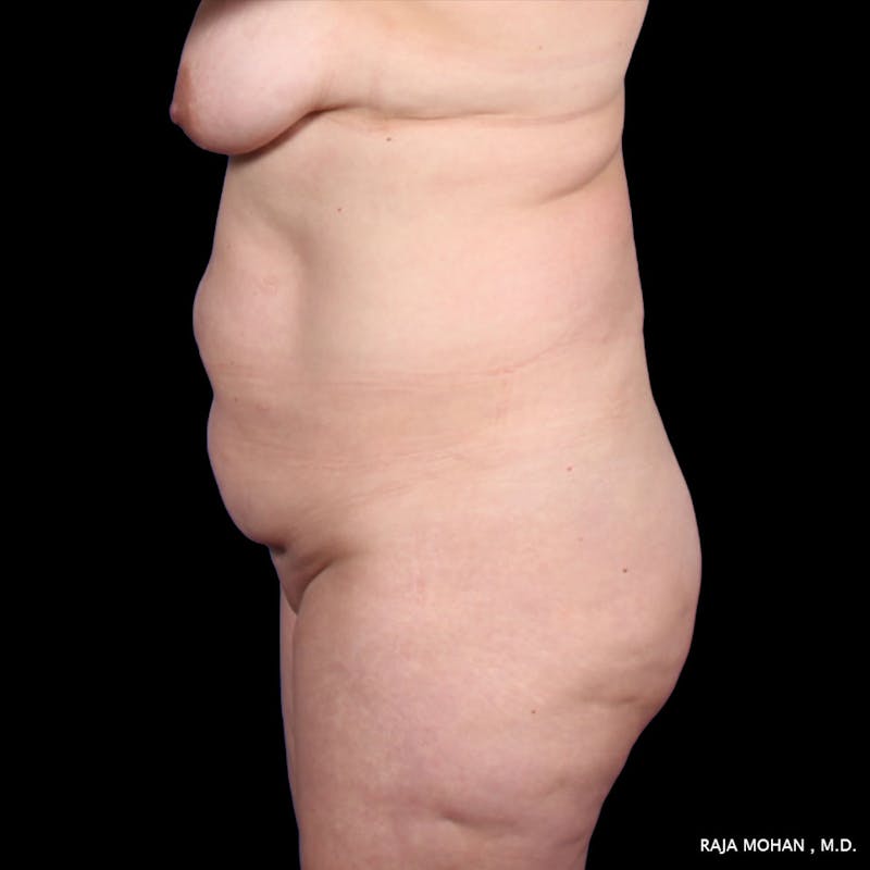 Tummy Tuck Before & After Gallery - Patient 392968 - Image 3