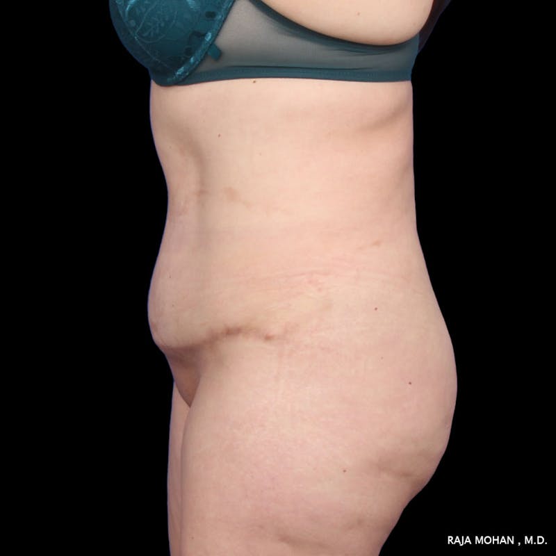 Tummy Tuck Before & After Gallery - Patient 392968 - Image 4