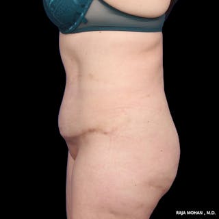 Tummy Tuck Before & After Gallery - Patient 392968 - Image 4