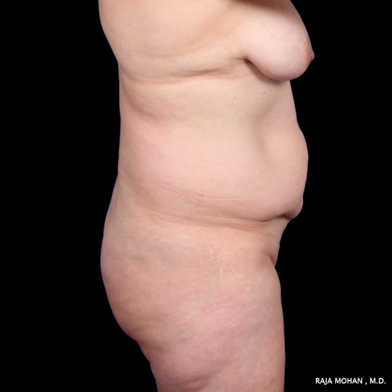 Tummy Tuck Before & After Gallery - Patient 392968 - Image 7