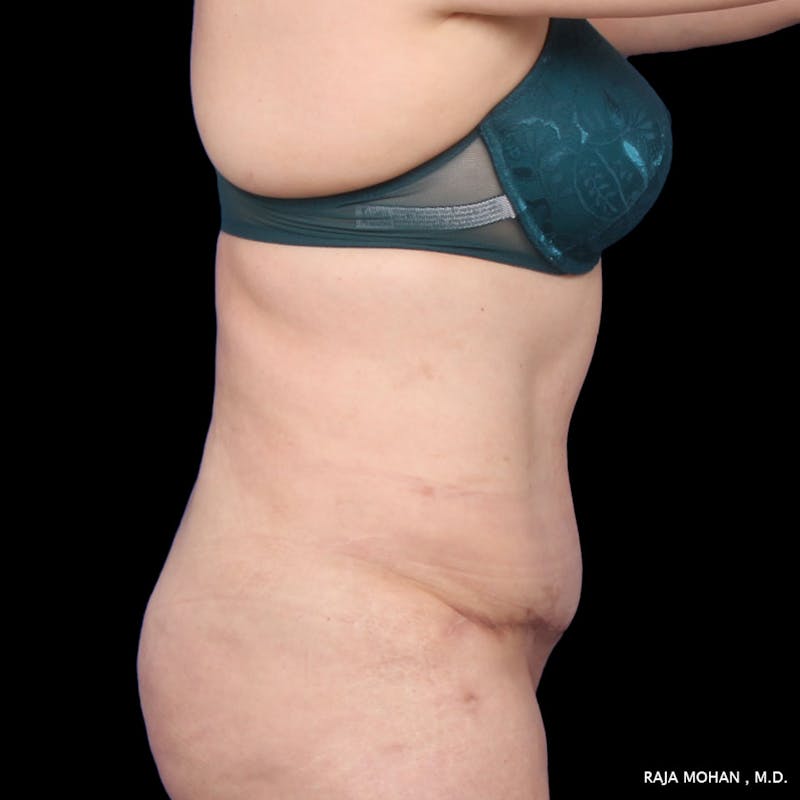 Tummy Tuck Before & After Gallery - Patient 392968 - Image 8