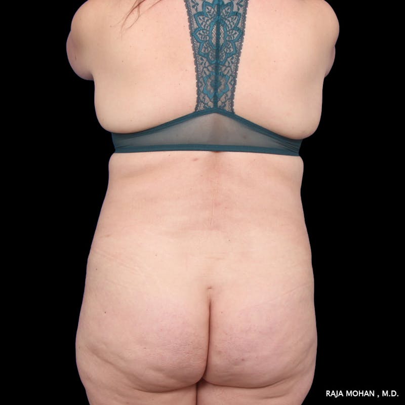 Tummy Tuck Before & After Gallery - Patient 392968 - Image 12
