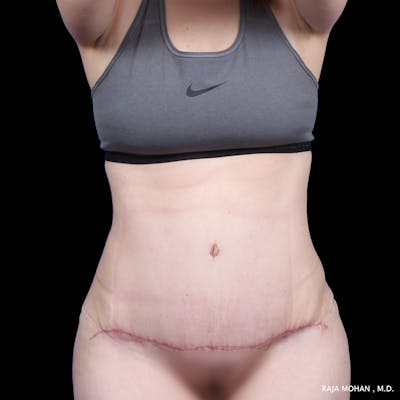 Tummy Tuck Before & After Gallery - Patient 277132 - Image 2