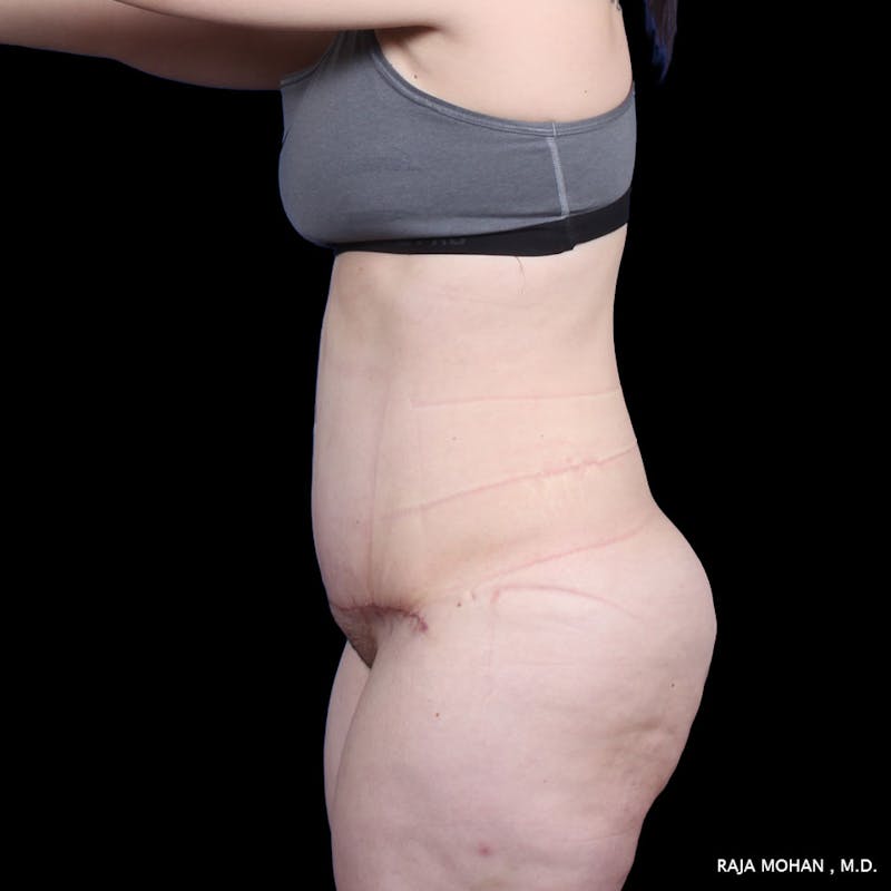 Tummy Tuck Before & After Gallery - Patient 277132 - Image 4