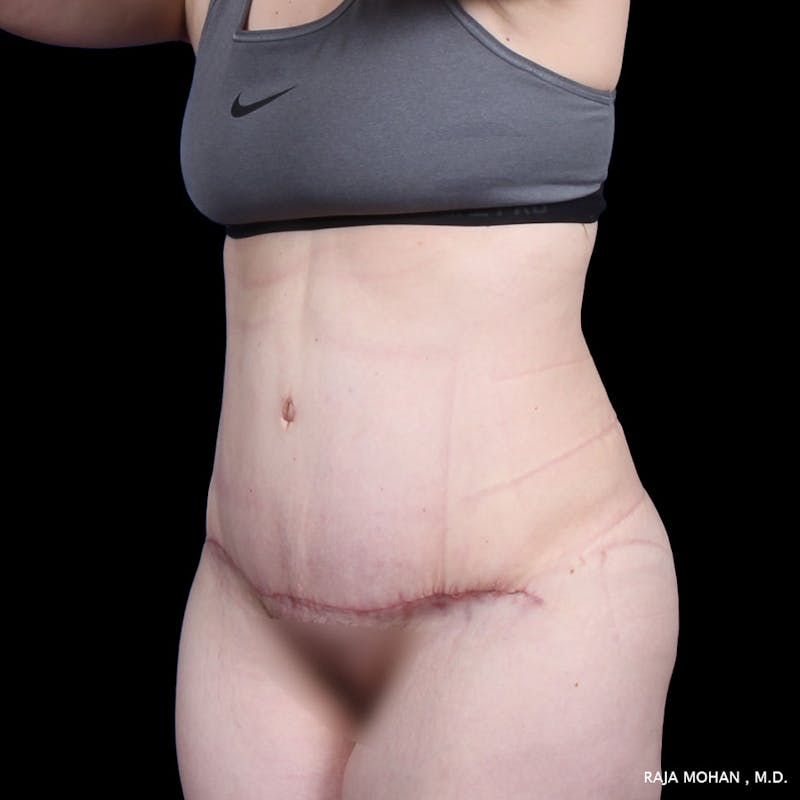 Tummy Tuck Before & After Gallery - Patient 277132 - Image 6