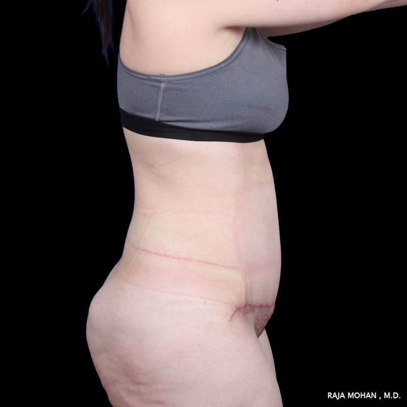 Tummy Tuck Before & After Gallery - Patient 277132 - Image 8